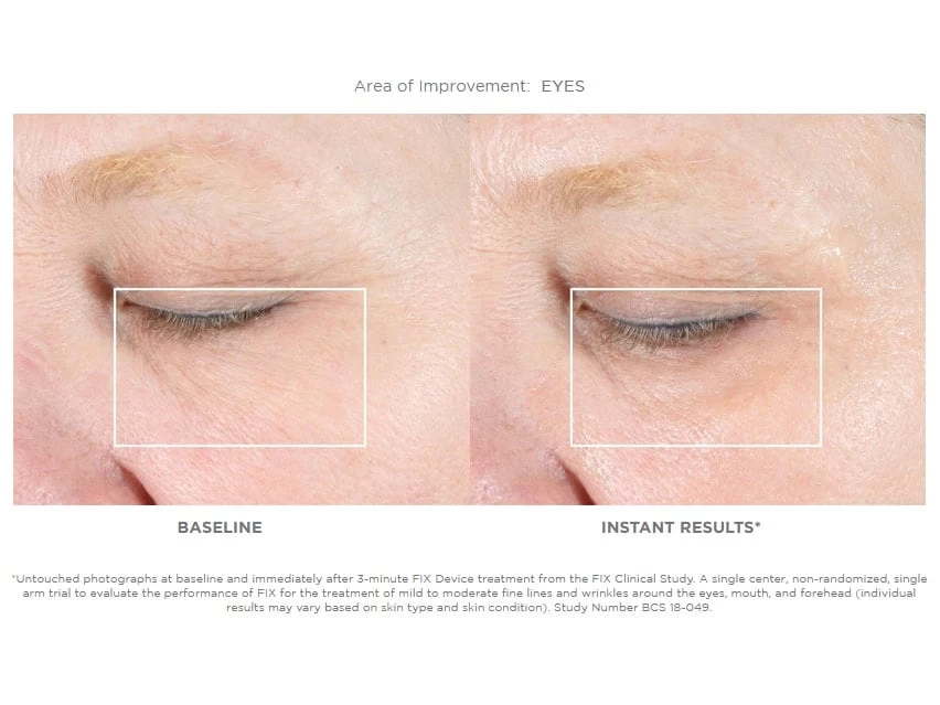 NuFACE FIX Starter Set 4 NuFACE FIX Starter Set - Image 2