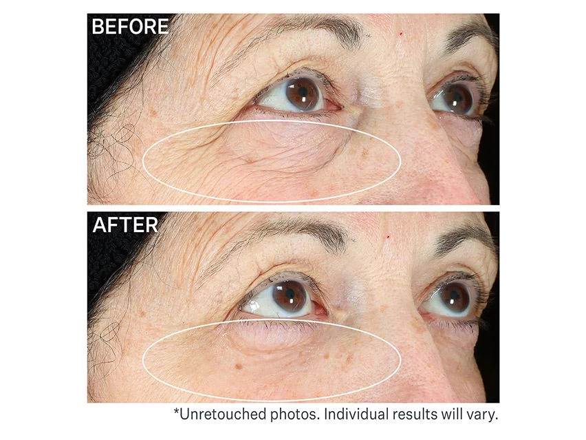 StriVectin Hyperlift Eye Instant Eye Fix 6 StriVectin Hyperlift Eye Instant Eye Fix - Image 4