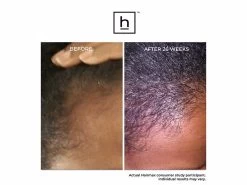 HairMax Ultima 12 LaserComb Hair Growth Device -Care Products Store 3lnbztqt 202211092012507295