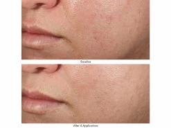 Obagi Medical Revivify Multi-Acid Facial Peel -Care Products Store 3pz21neu 202201272055042514