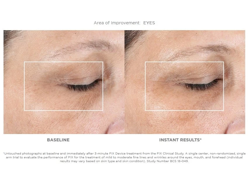 NuFACE FIX Starter Set 6 NuFACE FIX Starter Set - Image 4