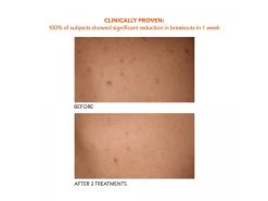 Dr. Dennis Gross Skincare Alpha Beta Exfoliating Body Treatment 22 Dr. Dennis Gross Skincare Alpha Beta Exfoliating Body Treatment -Care Products Store arbiwclu 202102011630075152