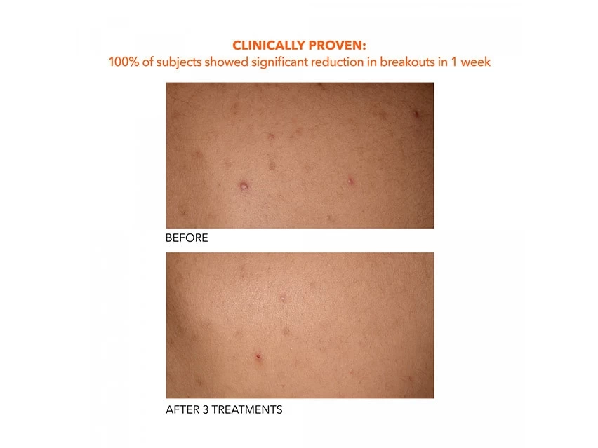 Dr. Dennis Gross Skincare Alpha Beta Exfoliating Body Treatment 12 Dr. Dennis Gross Skincare Alpha Beta Exfoliating Body Treatment - Image 10