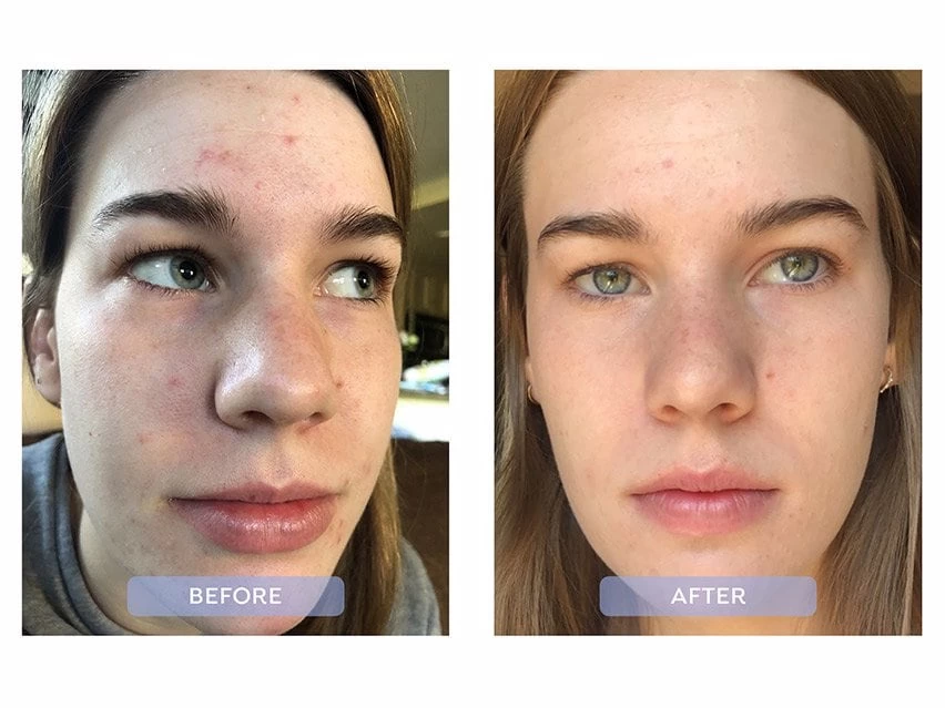 Dr. Zenovia Skincare 10% Benzoyl Peroxide Acne Cleanser 5 Dr. Zenovia Skincare 10% Benzoyl Peroxide Acne Cleanser - Image 3