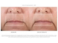 NuFACE FIX Starter Set 14 NuFACE FIX Starter Set -Care Products Store bagimkry 201902041814139032