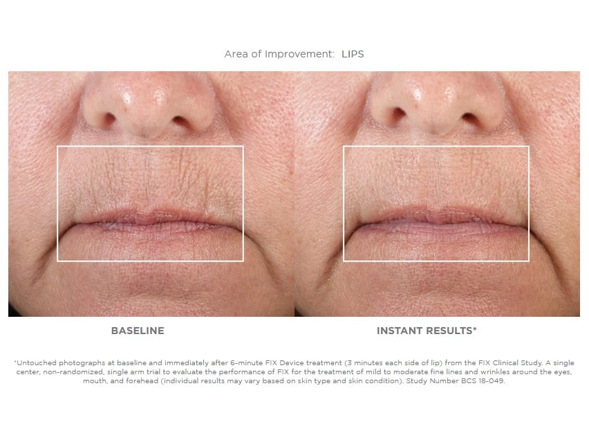 NuFACE FIX Starter Set 5 NuFACE FIX Starter Set - Image 3