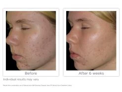 Glytone Acne Self-Foaming Cleanser 9 Glytone Acne Self-Foaming Cleanser -Care Products Store c4xub0rz 202011092215001646