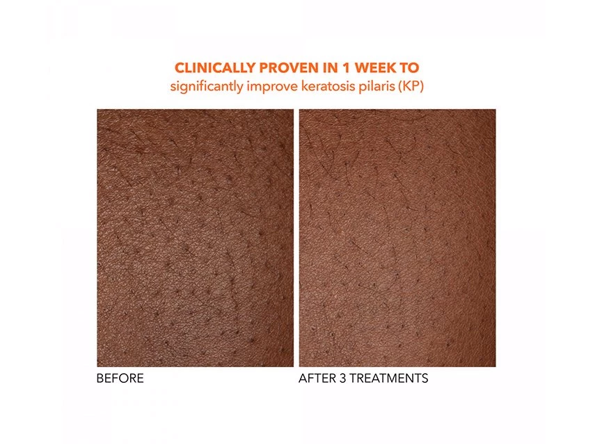 Dr. Dennis Gross Skincare Alpha Beta Exfoliating Body Treatment 10 Dr. Dennis Gross Skincare Alpha Beta Exfoliating Body Treatment - Image 8