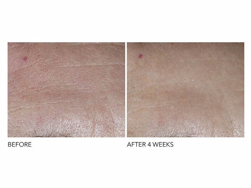 Dr. Dennis Gross Skincare Advanced Retinol + Ferulic Overnight Texture Renewal Peel 4 Dr. Dennis Gross Skincare Advanced Retinol + Ferulic Overnight Texture Renewal Peel - Image 2