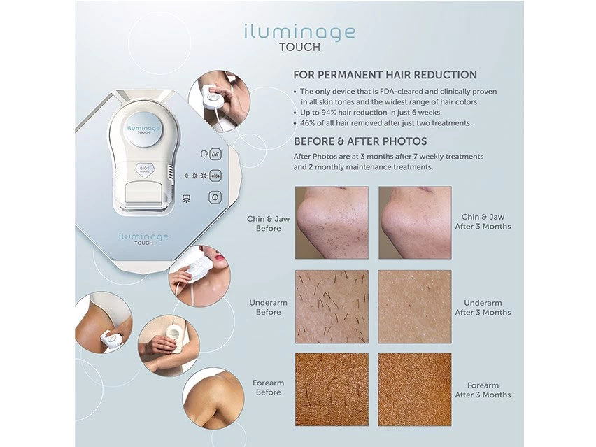 Iluminage Touch 4Ever Home Permanent Hair Removal IPL & Radio Frequency System 9 Iluminage Touch 4Ever Home Permanent Hair Removal IPL & Radio Frequency System - Image 7