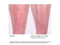 NassifMD® Eczema Soothing Skin Cream 12 NassifMD® Eczema Soothing Skin Cream -Care Products Store fwwvutij 202103051357087948