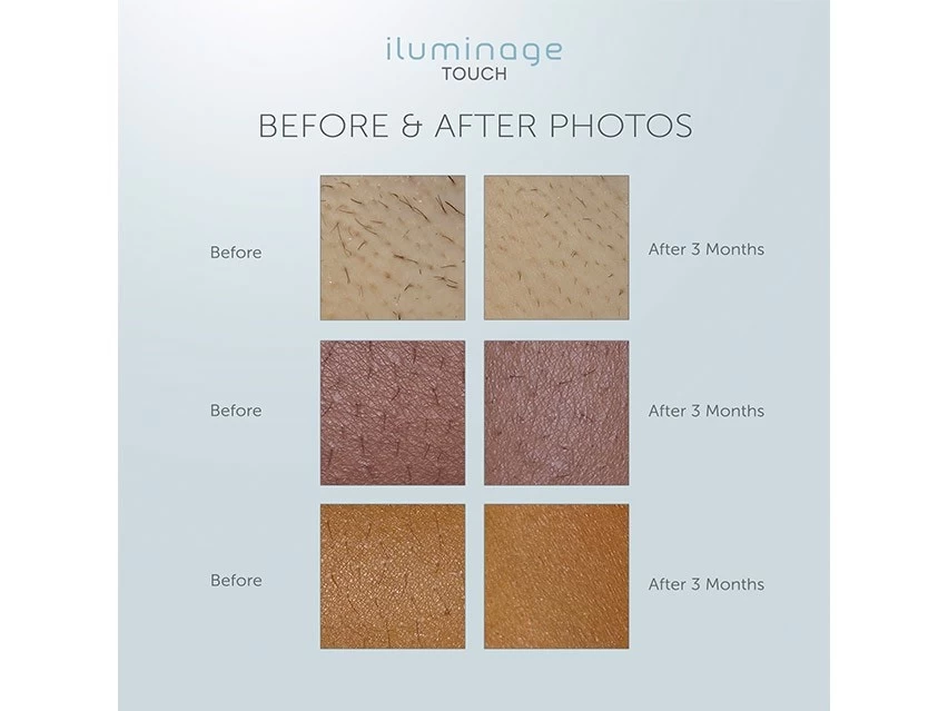 Iluminage Touch 4Ever Home Permanent Hair Removal IPL & Radio Frequency System 15 Iluminage Touch 4Ever Home Permanent Hair Removal IPL & Radio Frequency System - Image 13