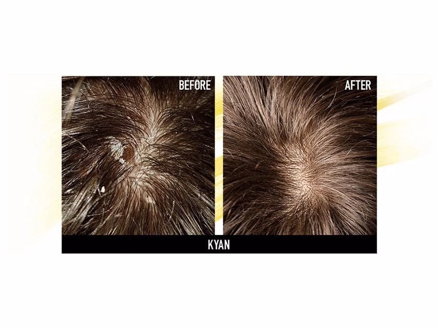 Hairsanity Anti-Dandruff Conditioner 7 Hairsanity Anti-Dandruff Conditioner - Image 5