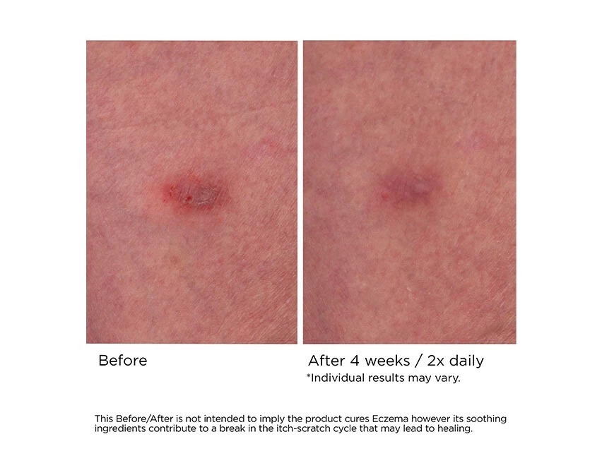 NassifMD® Eczema Soothing Skin Cream 6 NassifMD® Eczema Soothing Skin Cream - Image 4