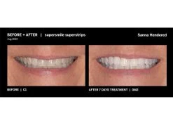 Supersmile Professional Teeth Whitening Superstrips -Care Products Store qzanut2k 202211091655358233