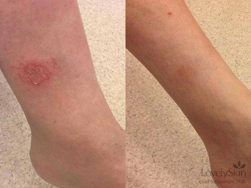 FixMySkin 1% Hydrocortisone Healing Body Balm – Fragrance-Free 5 FixMySkin 1% Hydrocortisone Healing Body Balm – Fragrance-Free - Image 3