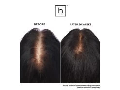 HairMax Ultima 12 LaserComb Hair Growth Device -Care Products Store unz1nw5e 202211092015318706