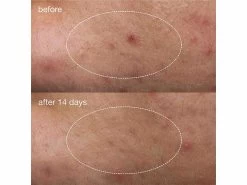 Dermalogica Deep Acne Liquid Patch 14 Dermalogica Deep Acne Liquid Patch -Care Products Store x3kwd1qn 202305111850175264