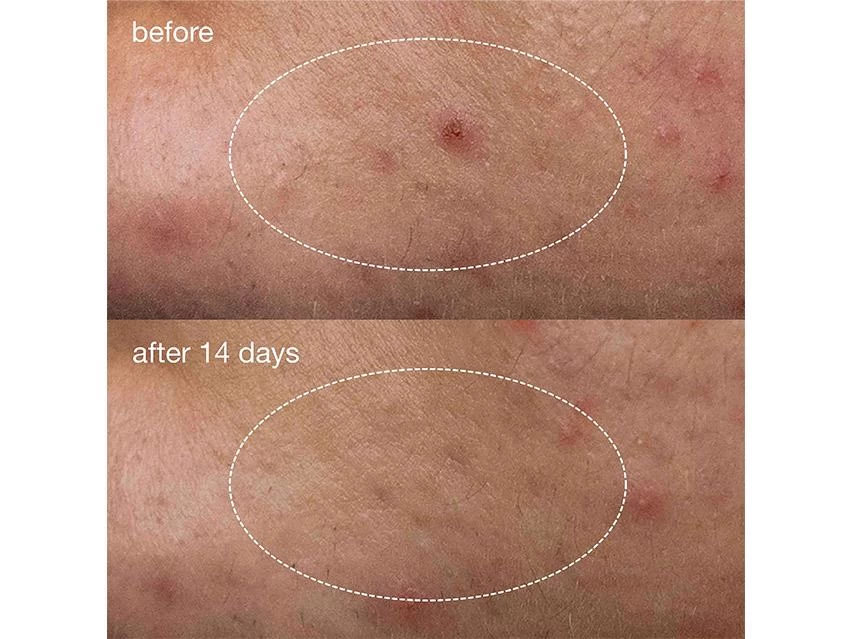 Dermalogica Deep Acne Liquid Patch 6 Dermalogica Deep Acne Liquid Patch - Image 4