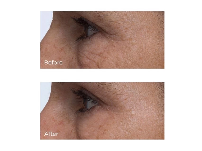 Perricone MD Cold Plasma Plus+ Eye Advanced Eye Cream 6 Perricone MD Cold Plasma Plus+ Eye Advanced Eye Cream - Image 4