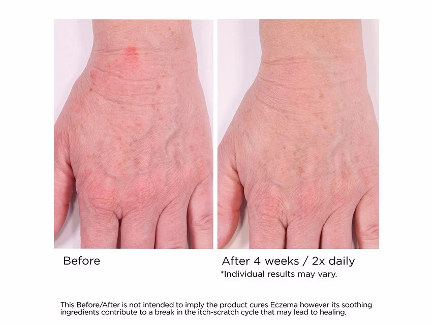 NassifMD® Eczema Soothing Skin Cream 5 NassifMD® Eczema Soothing Skin Cream - Image 3